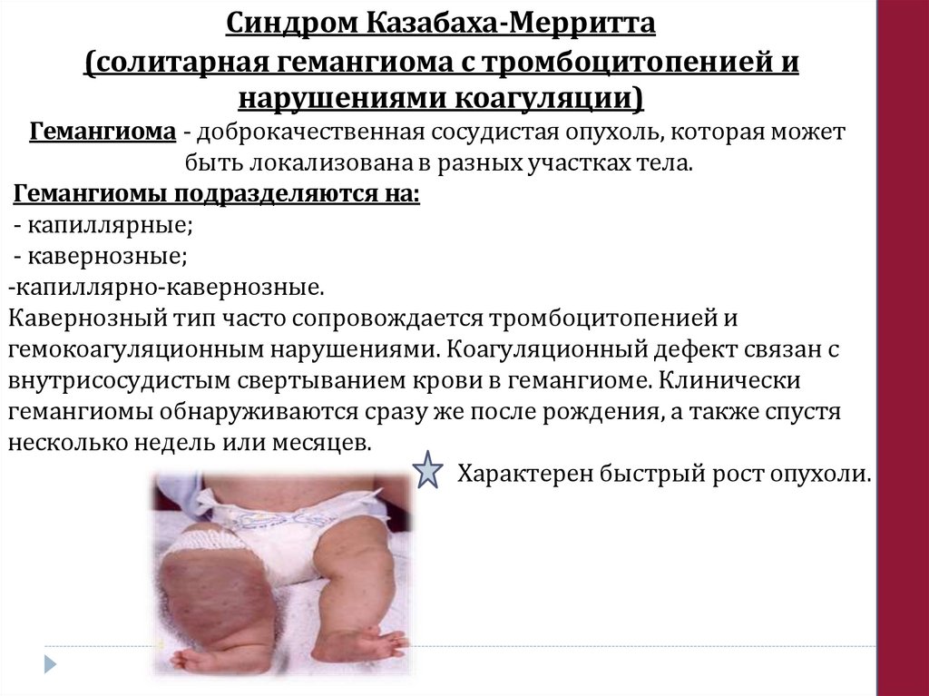 Синдром Казабаха-Мерритта (солитарная гемангиома с тромбоцитопенией и нарушениями коагуляции)