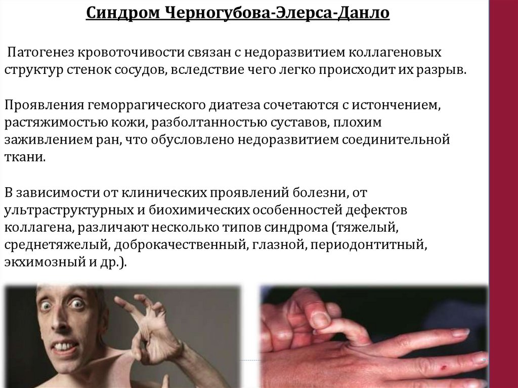 Синдром Черногубова-Элерса-Данло