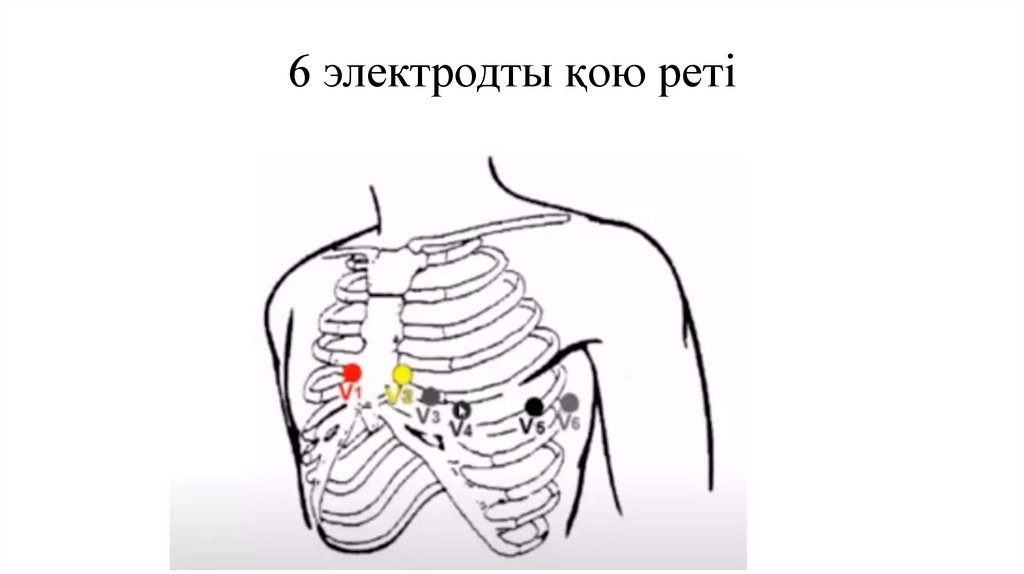 6 электродты қою реті