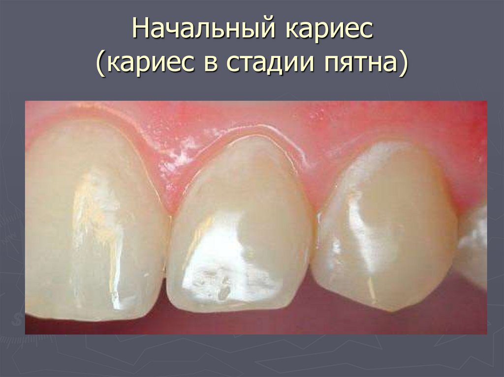 Начальный кариес (кариес в стадии пятна)