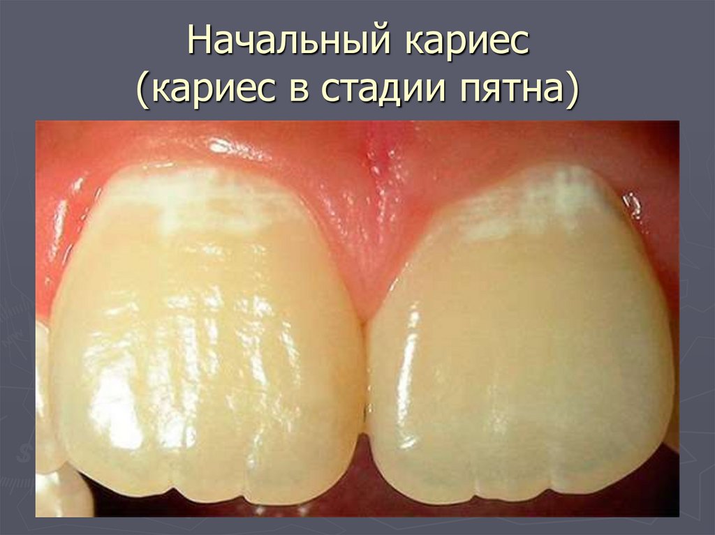 Начальный кариес (кариес в стадии пятна)