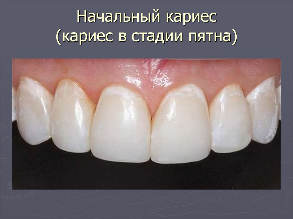 Начальный кариес (кариес в стадии пятна)