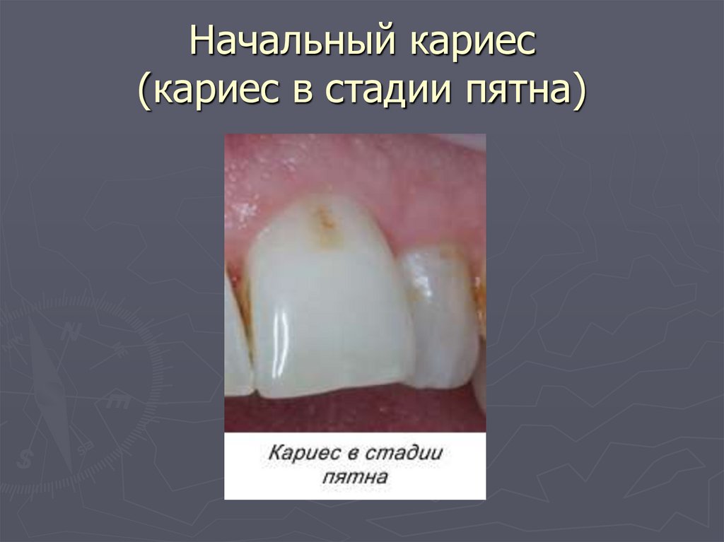 Начальный кариес (кариес в стадии пятна)