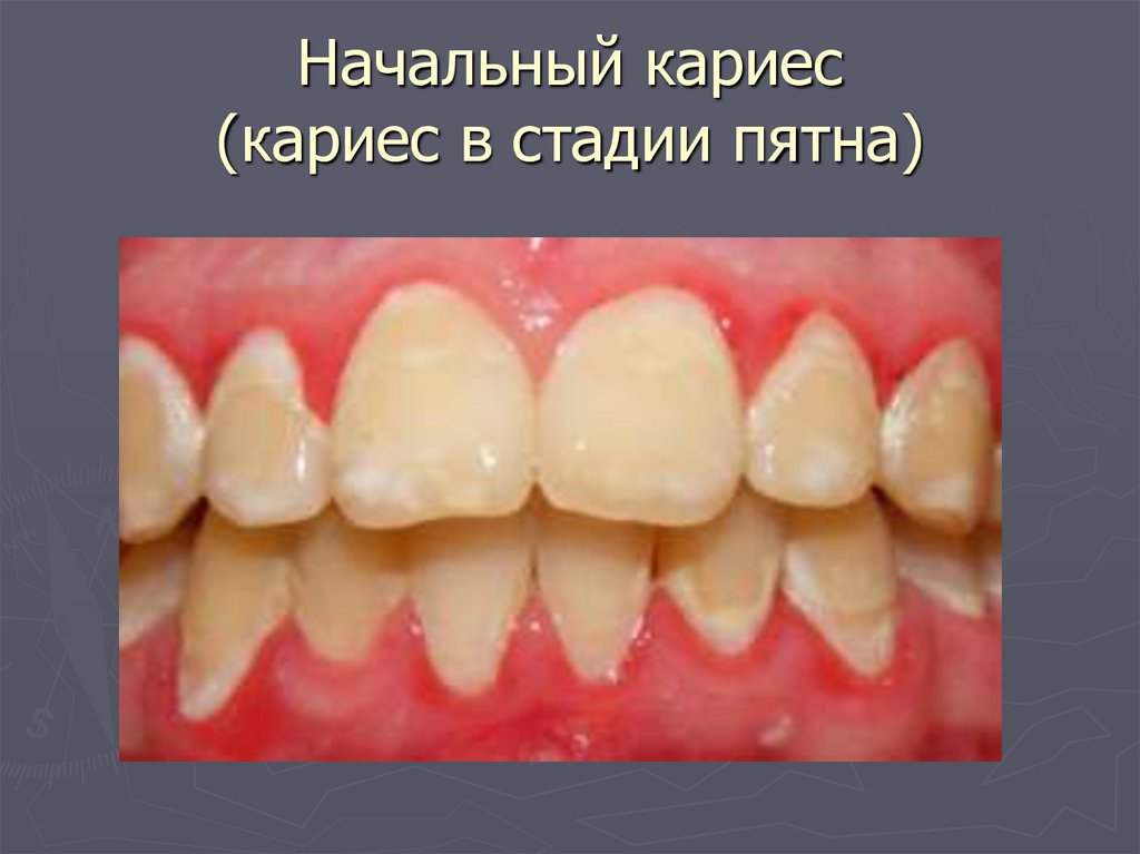 Начальный кариес (кариес в стадии пятна)