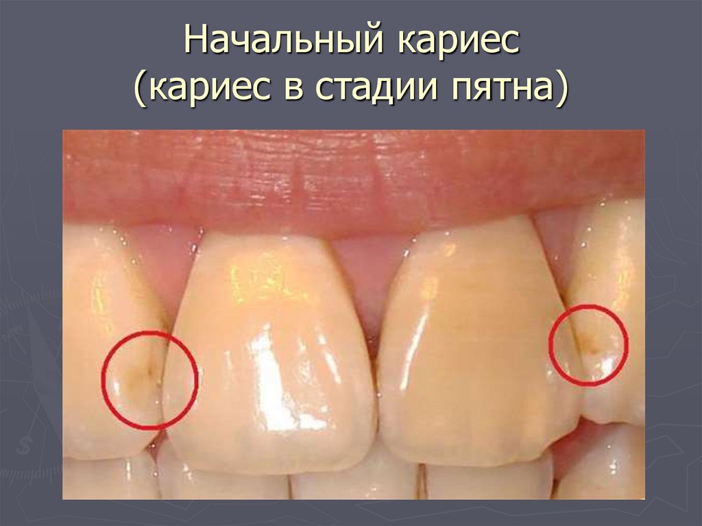 Начальный кариес (кариес в стадии пятна)