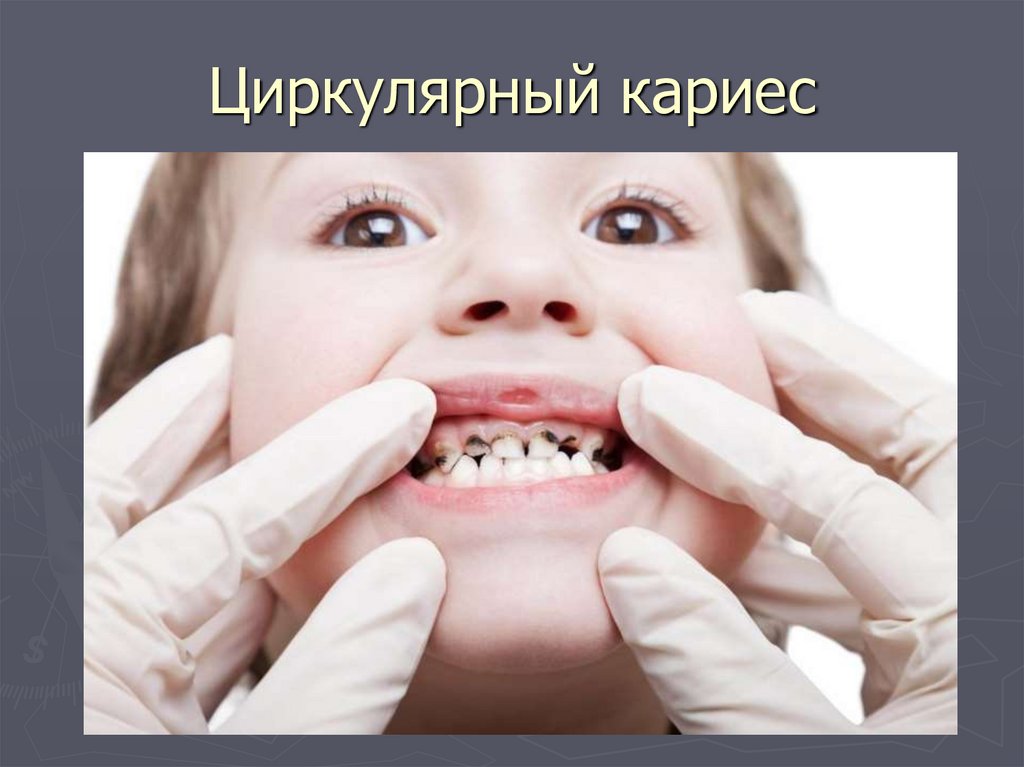 Циркулярный кариес