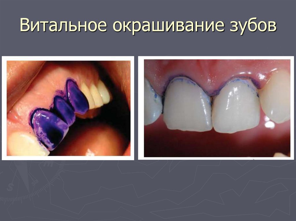 Витальное окрашивание зубов