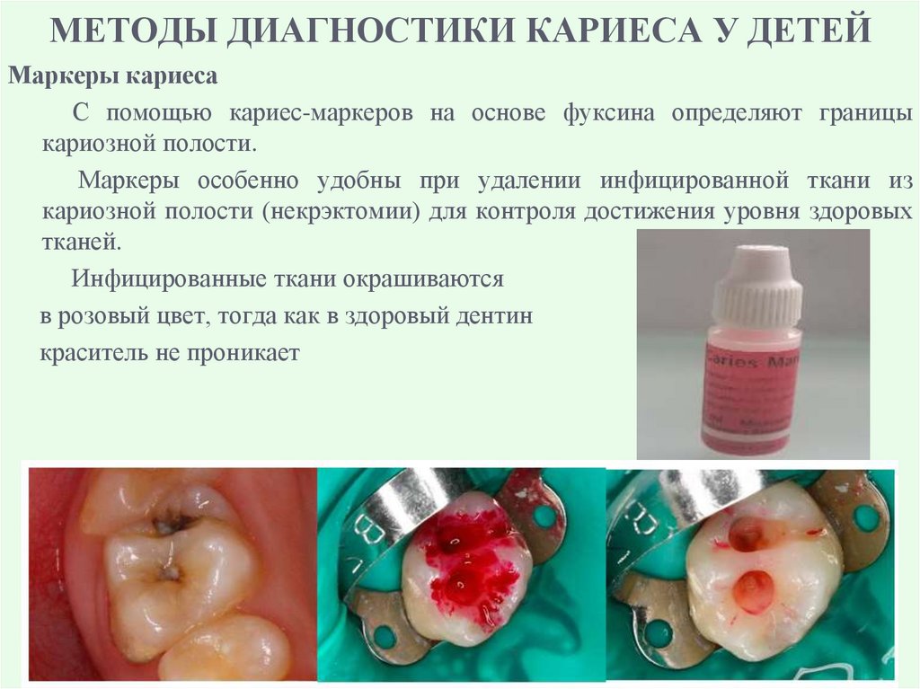 МЕТОДЫ ДИАГНОСТИКИ КАРИЕСА У ДЕТЕЙ