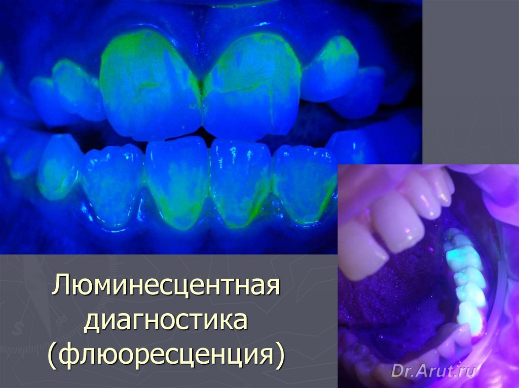 Люминесцентная диагностика (флюоресценция)