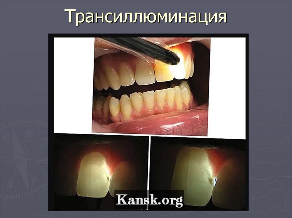 Трансиллюминация