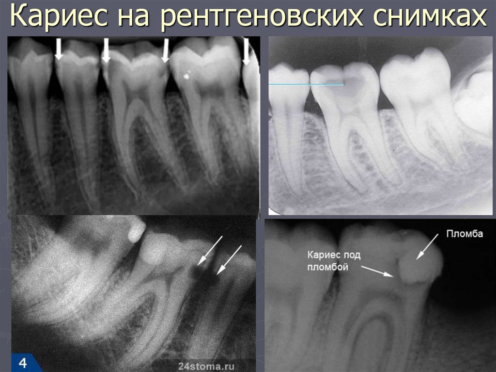Кариес на рентгеновских снимках