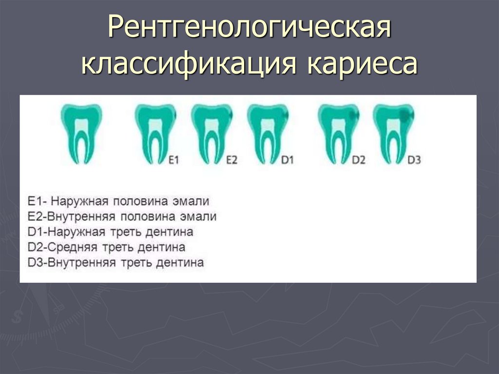 Рентгенологическая классификация кариеса