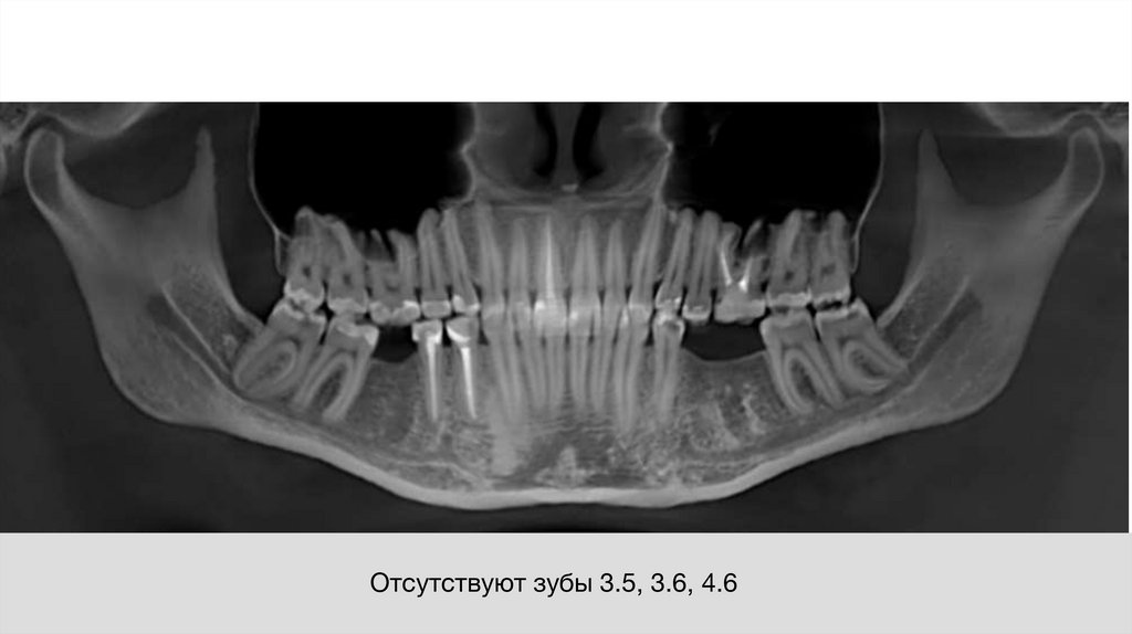Отсутствуют зубы 3.5, 3.6, 4.6
