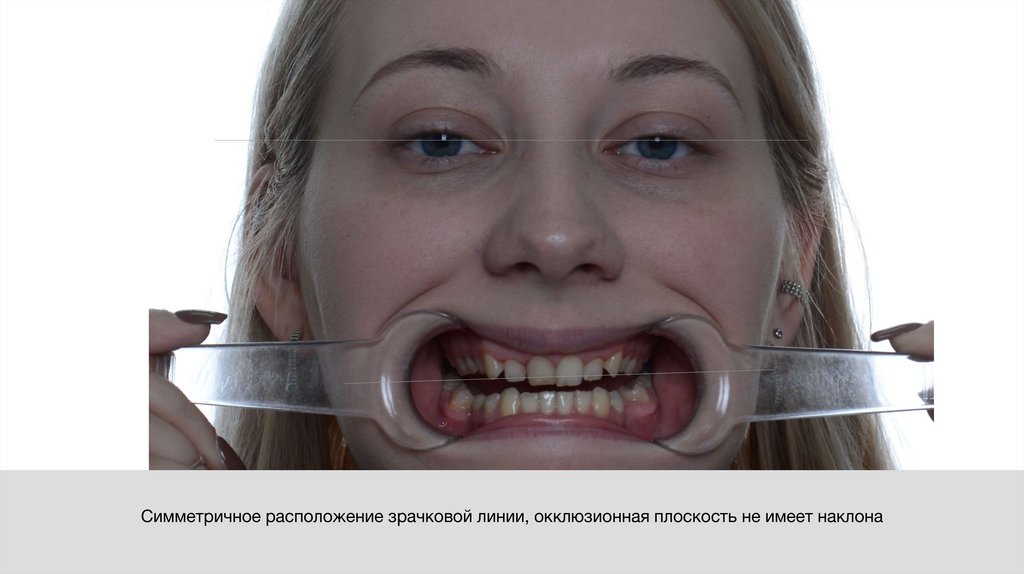 Симметричное расположение зрачковой линии, окклюзионная плоскость не имеет наклона