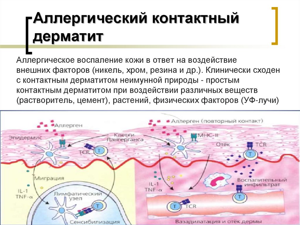 Аллергический контактный дерматит