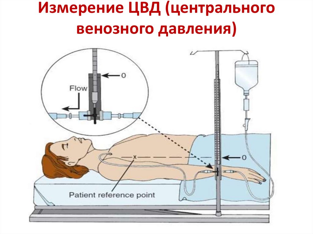 Измерение ЦВД (центрального венозного давления)