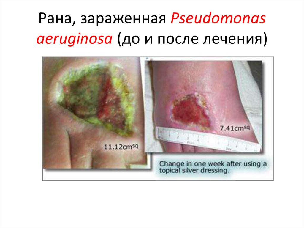 Рана, зараженная Pseudomonas aeruginosa (до и после лечения)