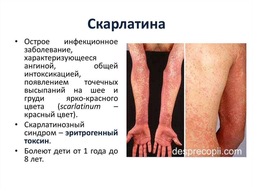 Скарлатина