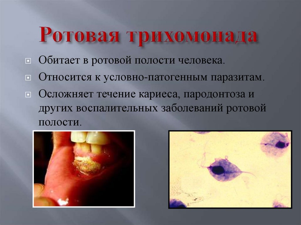 Ротовая трихомонада