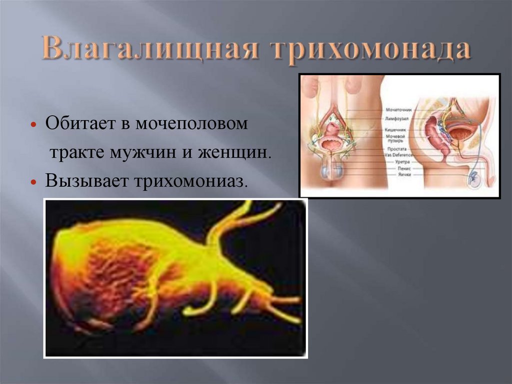 Влагалищная трихомонада