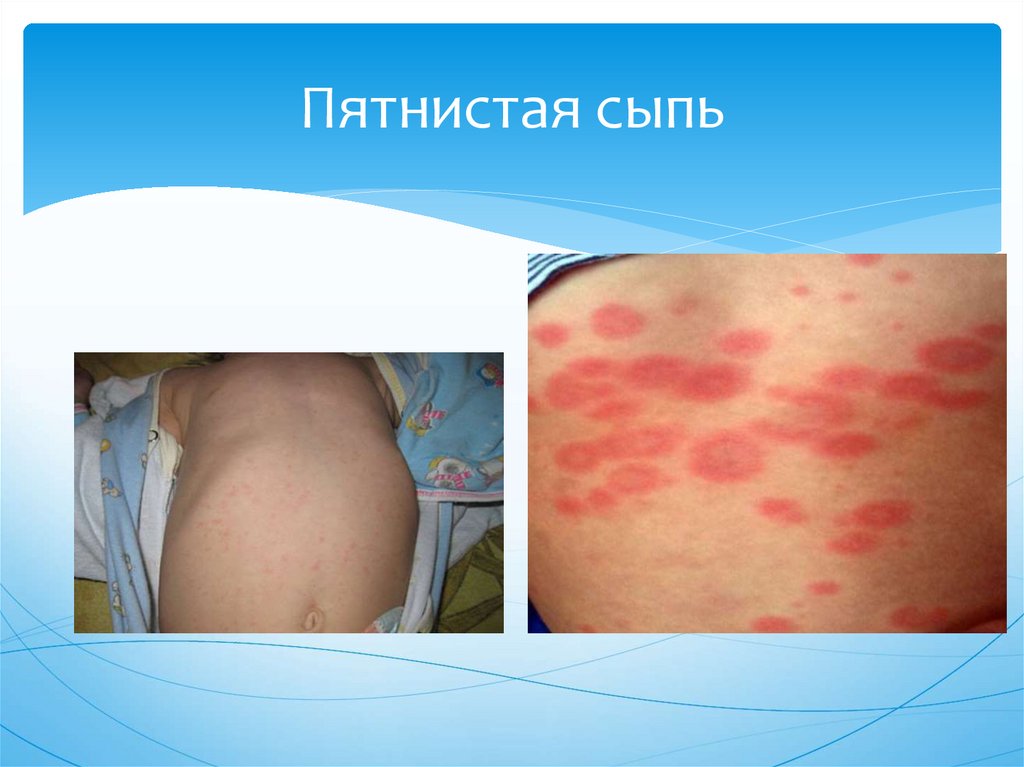 Пятнистая сыпь