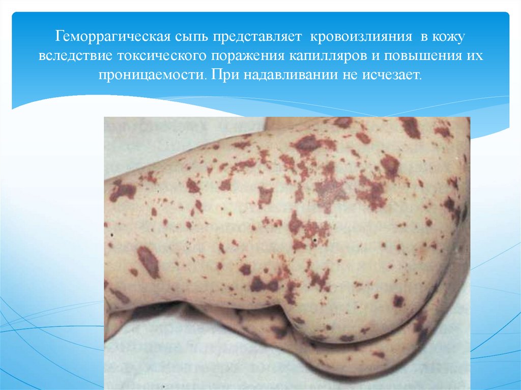 Геморрагическая сыпь представляет кровоизлияния в кожу вследствие токсического поражения капилляров и повышения их