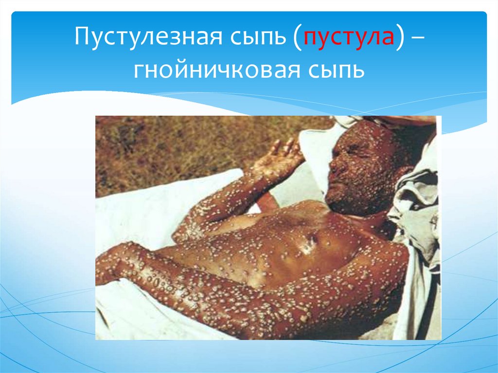 Пустулезная сыпь (пустула) –гнойничковая сыпь