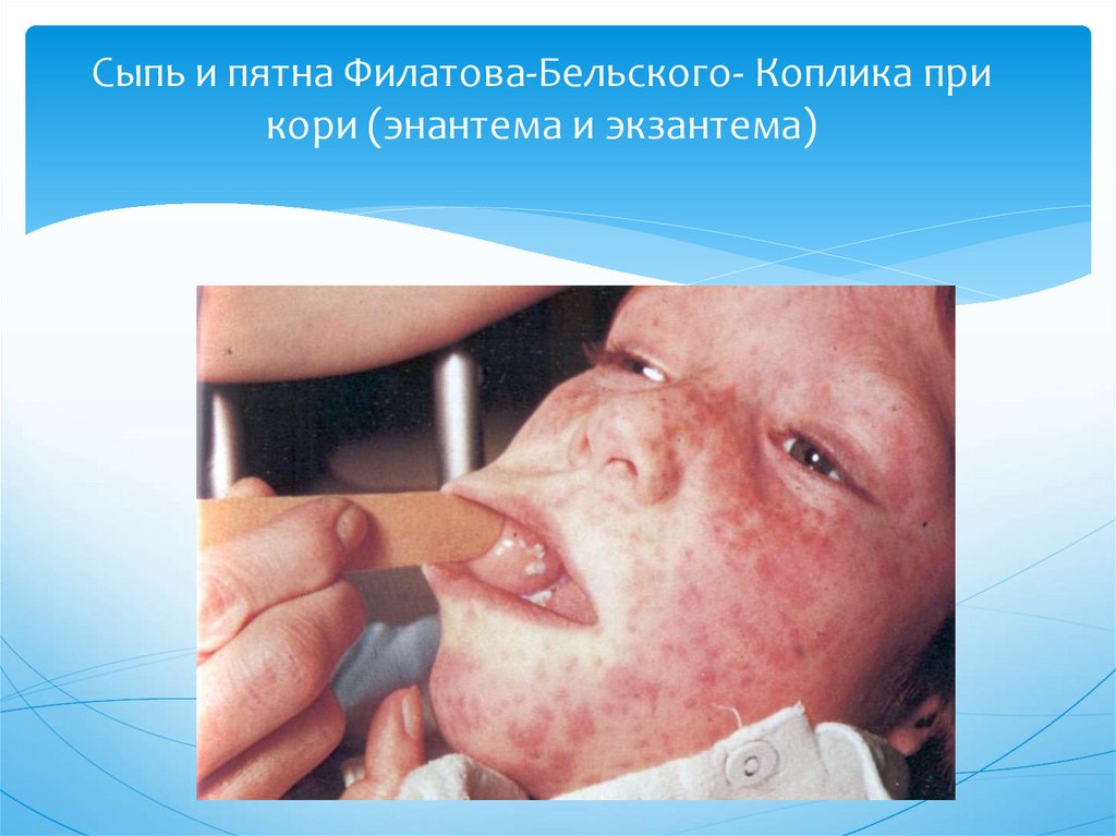 Сыпь и пятна Филатова-Бельского- Коплика при кори (энантема и экзантема)