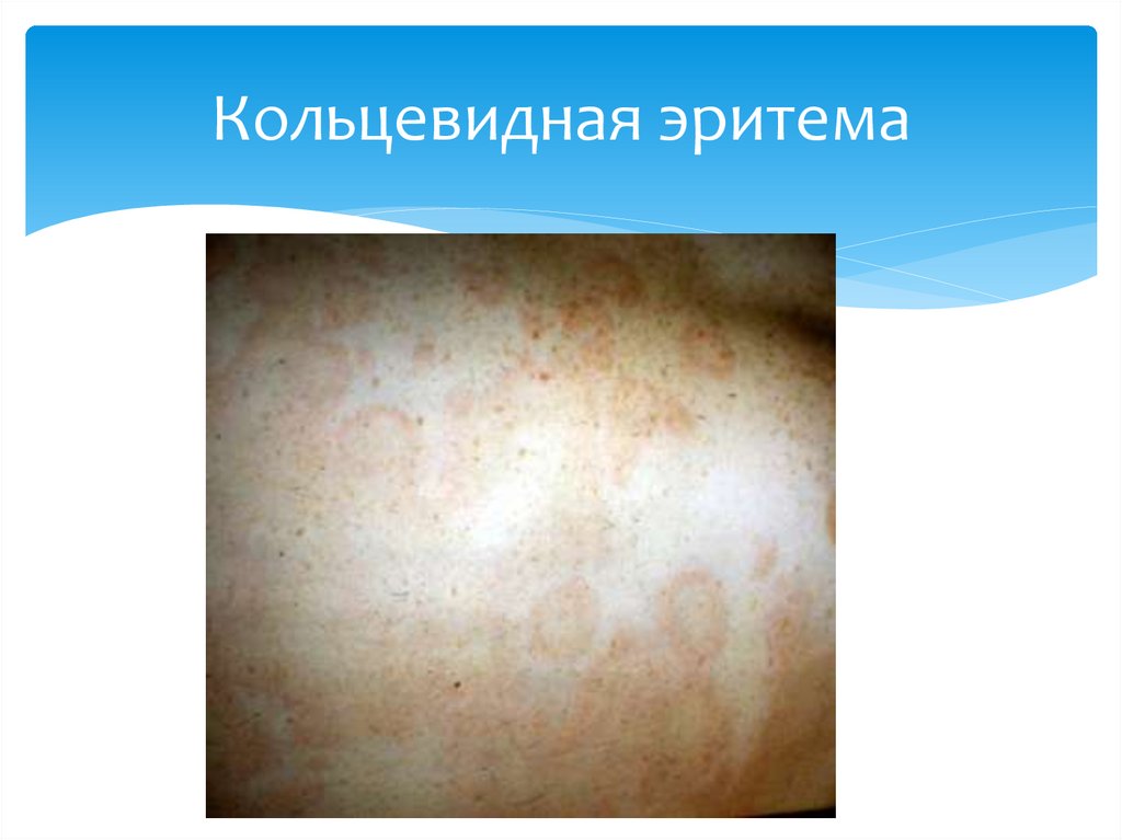 Кольцевидная эритема