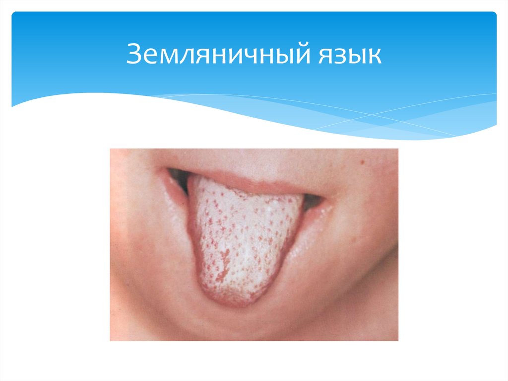 Земляничный язык