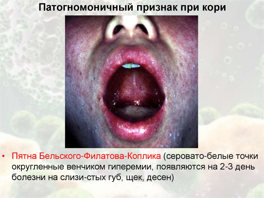 Патогномоничный признак при кори