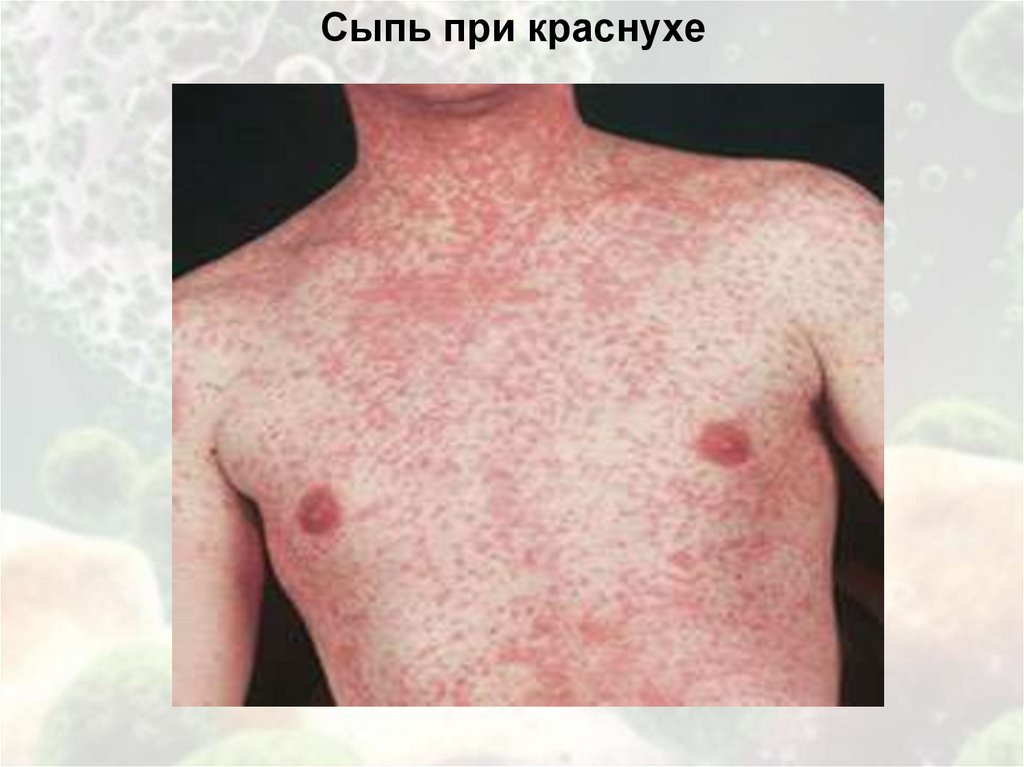 Сыпь при краснухе