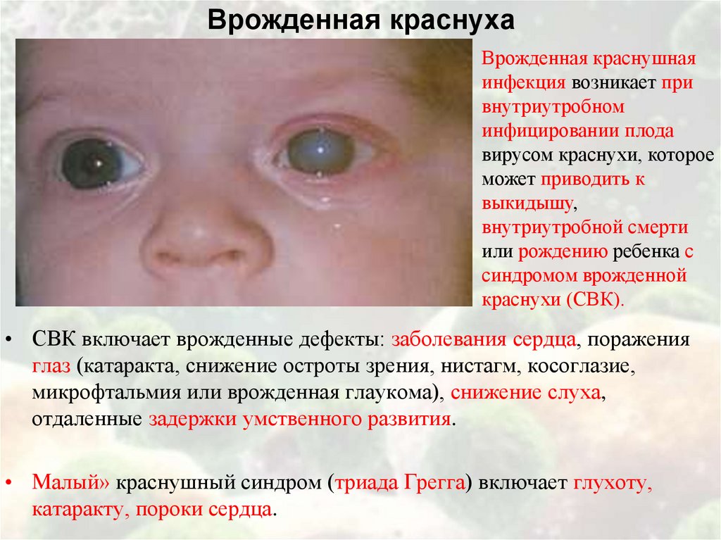 Врожденная краснуха