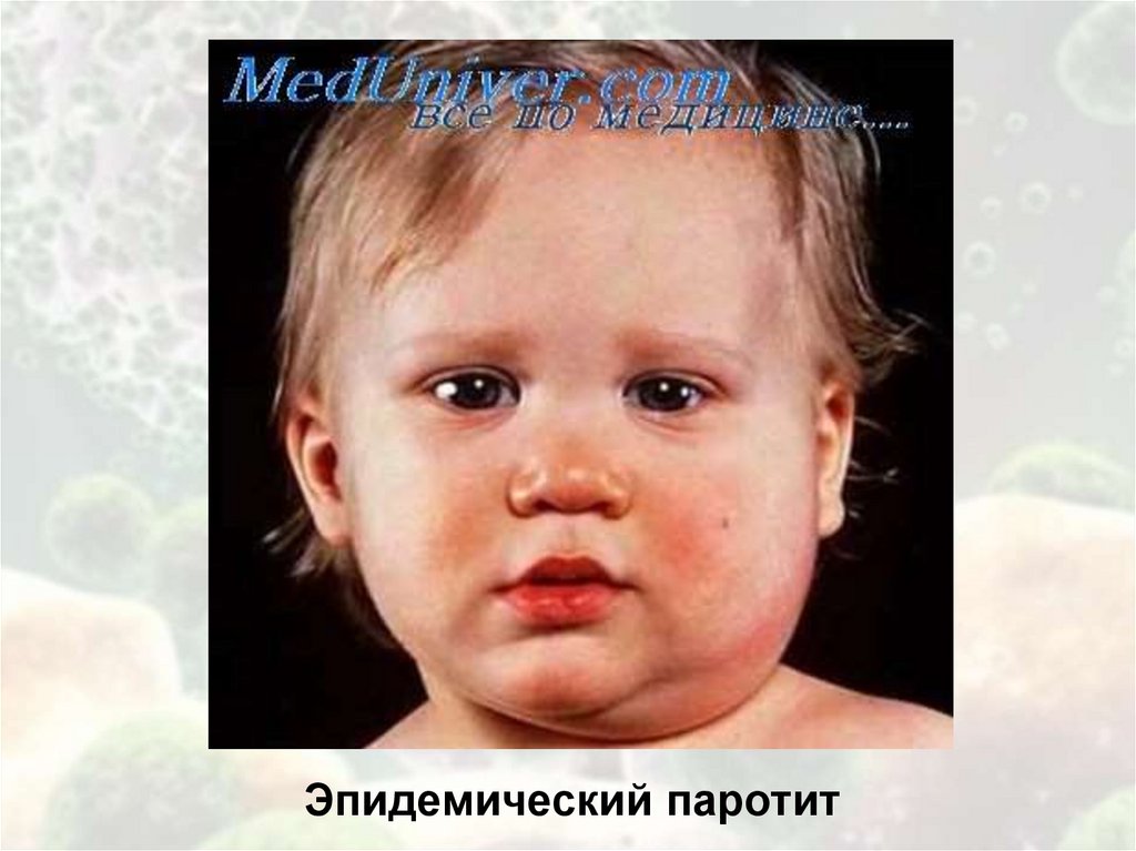 Эпидемический паротит