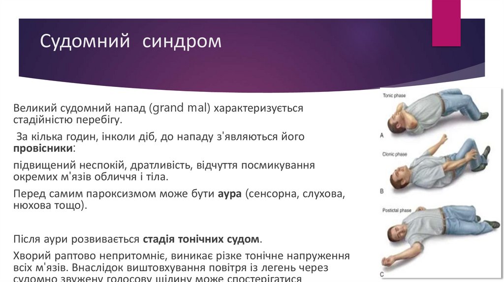 Судомний синдром