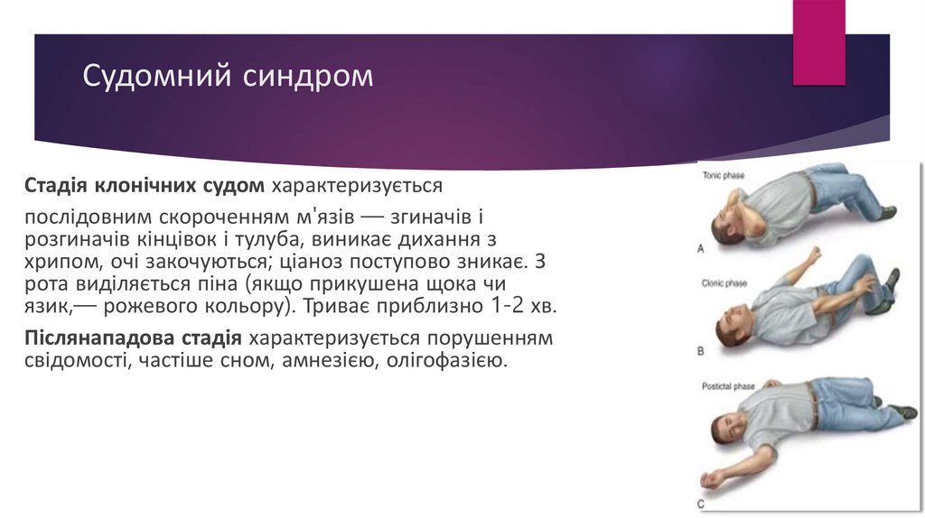 Судомний синдром