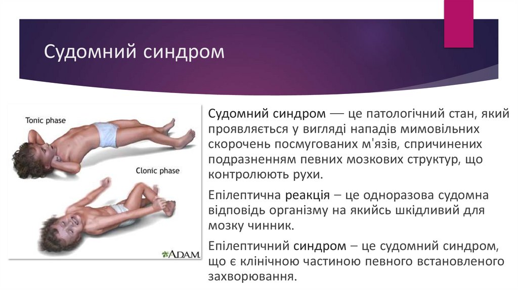 Судомний синдром