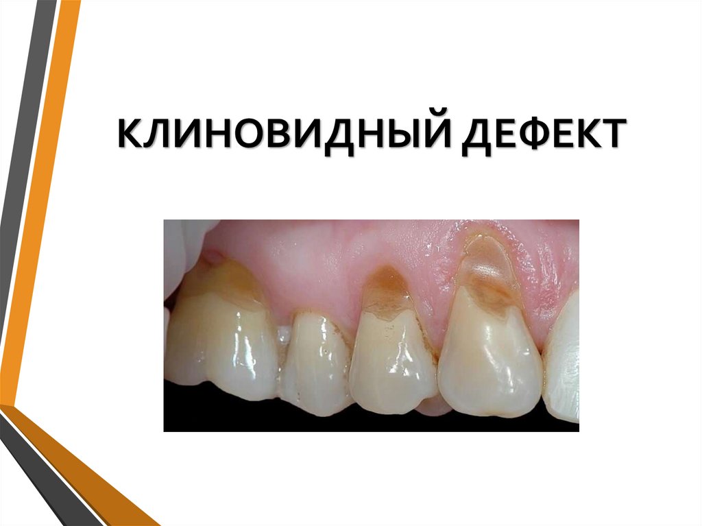 КЛИНОВИДНЫЙ ДЕФЕКТ