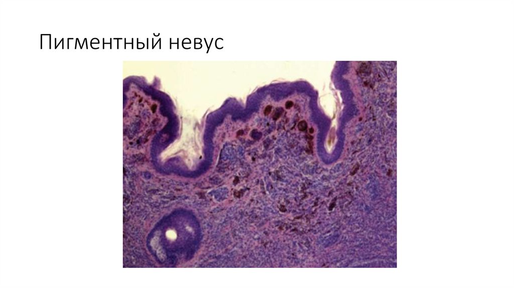 Пигментный невус