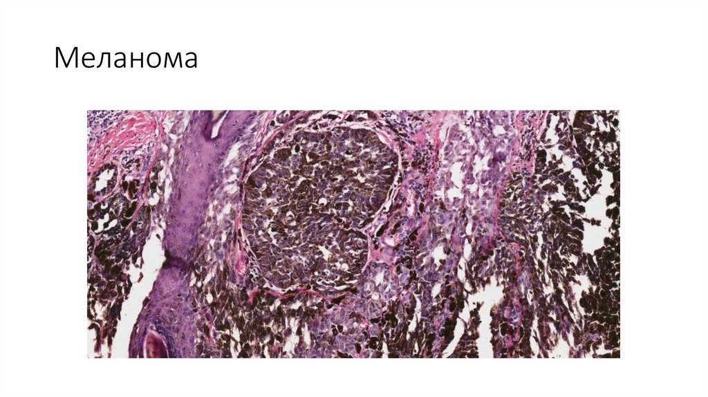 Меланома