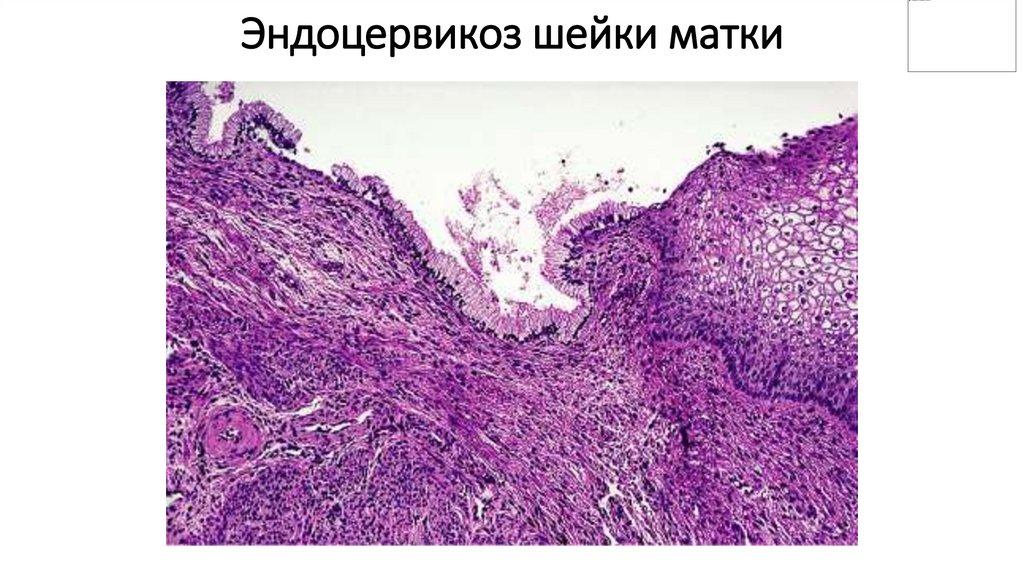 Эндоцервикоз шейки матки