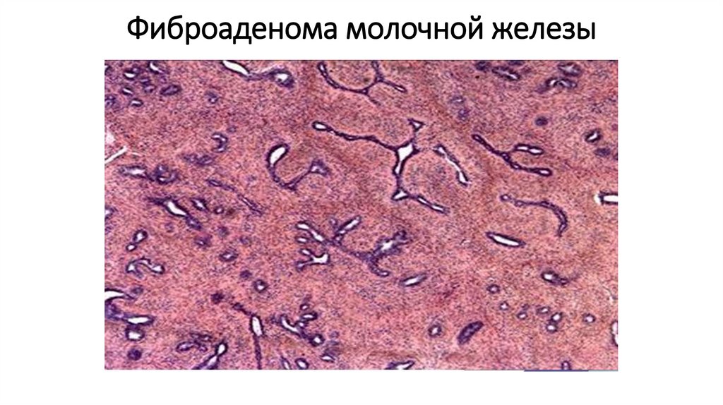 Фиброаденома молочной железы