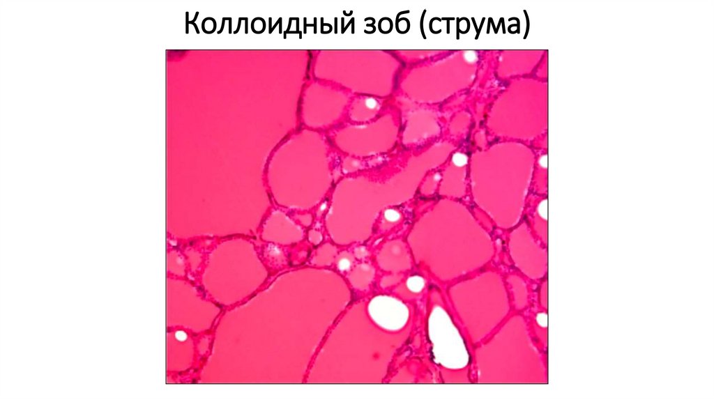 Коллоидный зоб (струма)