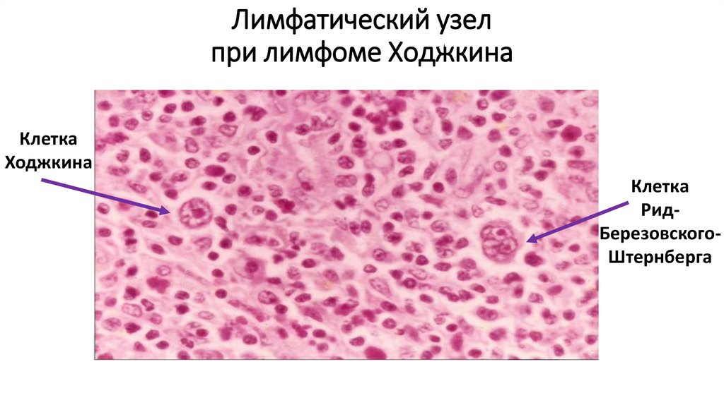Лимфатический узел при лимфоме Ходжкина