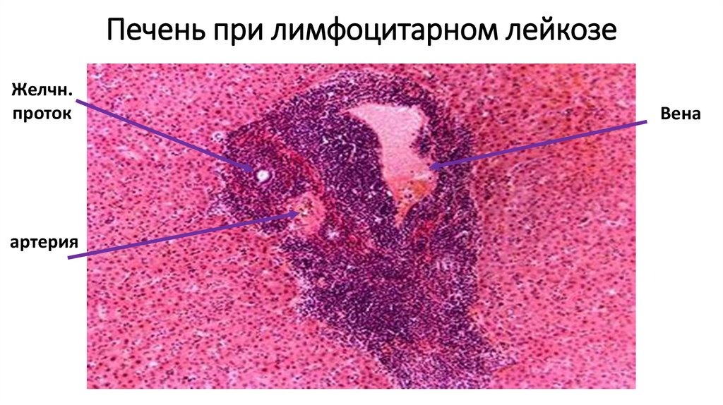 Печень при лимфоцитарном лейкозе