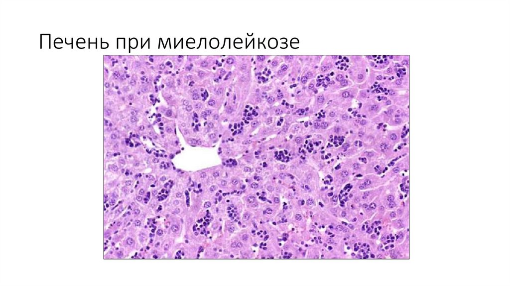 Печень при миелолейкозе