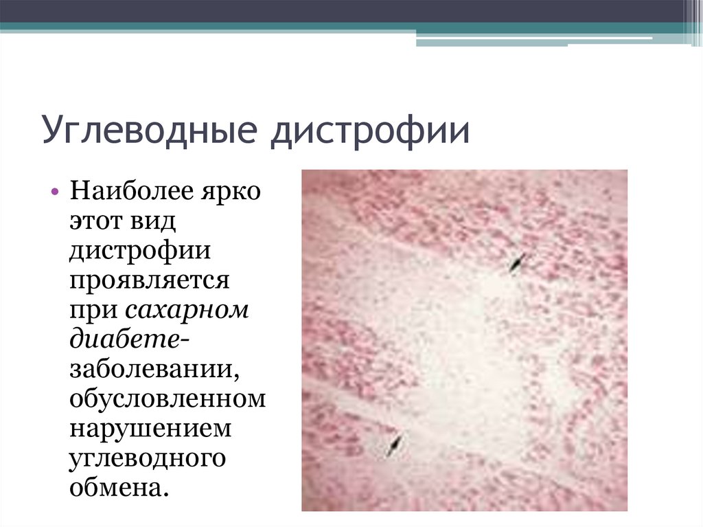 Углеводные дистрофии