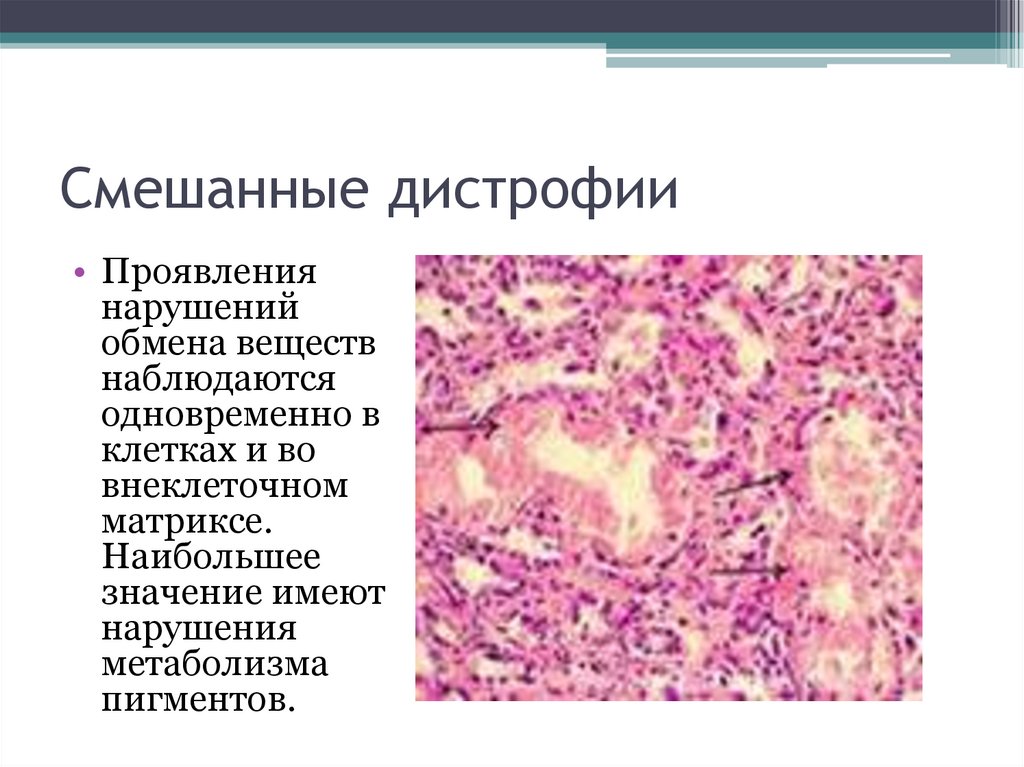 Смешанные дистрофии