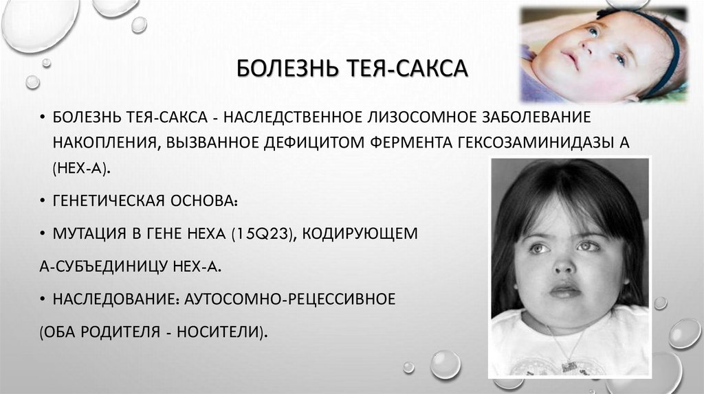 Болезнь тея-сакса