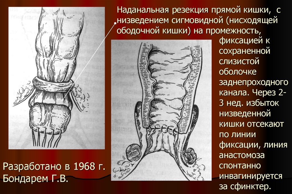 Может ли вылезти кишка. Может ли вылезти кишка